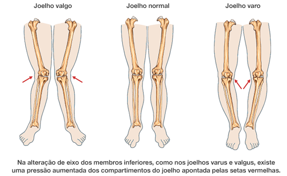 Dr. Marcelo Tostes Dr. Marcelo Tostes: Na alteração de eixo dos membros inferiores, como nos joelhos varus e valgus, existe uma pressão aumentada dos compartimentos do joelho apontada pelas setas vermelhas.