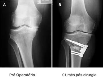 Dr. Marcelo Tostes Dr. Marcelo Tostes: Cirurgia - Osteotomia