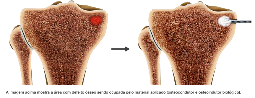 Dr. Marcelo Tostes Dr. Marcelo Tostes: A imagem acima mostra a área com defeito ósseo sendo ocupada pelo material aplicado (osteocondutor e osteoindutor biológico).