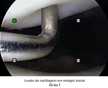 Dr. Marcelo Tostes Dr. Marcelo Tostes: Lesão da cartilagem em estagio inicial