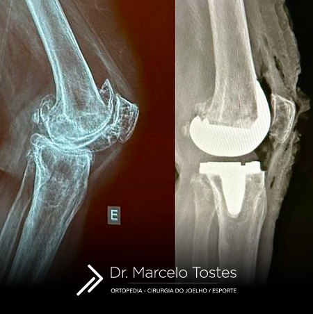 Dr. Marcelo Tostes Dr. Marcelo Tostes: Cirurgia - Prótese de joelho