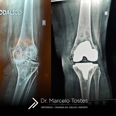 Dr. Marcelo Tostes Dr. Marcelo Tostes: Cirurgia - Prótese de joelho