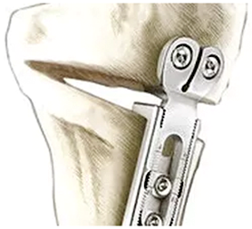 Dr. Marcelo Tostes Dr. Marcelo Tostes: Cirurgia - Osteotomia