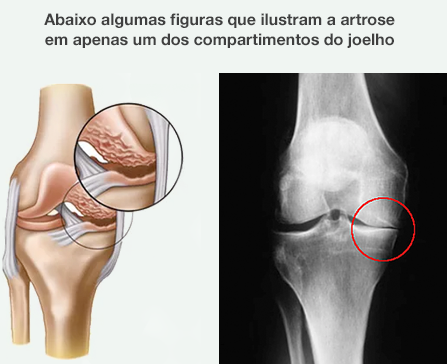 Dr. Marcelo Tostes Dr. Marcelo Tostes: Abaixo algumas figuras que ilustram a artrose
em apenas um dos compartimentos do joelho