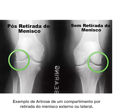 Dr. Marcelo Tostes Dr. Marcelo Tostes: Exemplo de Artrose de um compartimento por retirada do menisco externo ou lateral.