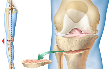 Dr. Marcelo Tostes Dr. Marcelo Tostes: Cirurgia - Osteotomia