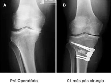 Dr. Marcelo Tostes – Osteotomia da Tíbia