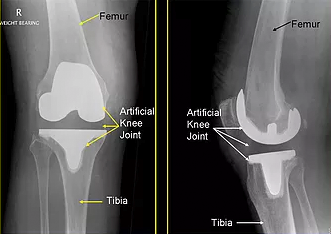 Dr. Marcelo Tostes Dr. Marcelo Tostes: Cirurgia - Prótese de joelho