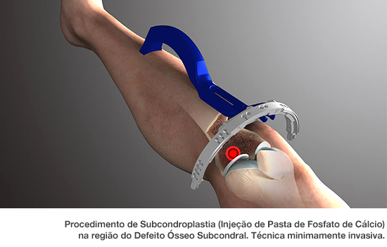 Dr. Marcelo Tostes Dr. Marcelo Tostes: Procedimento de Subcondroplastia (Injeção de Pasta de Fosfato de Cálcio) na região do Defeito Ósseo Subcondral. Técnica minimamente invasiva.