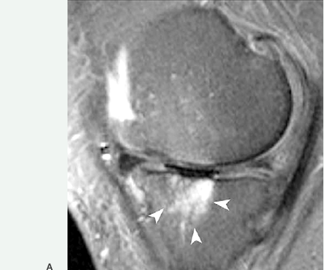 Dr. Marcelo Tostes Dr. Marcelo Tostes: As imagens abaixo mostram uma área de defeito ósseo subcondral visto à Ressonância Magnética.