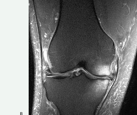 Dr. Marcelo Tostes Dr. Marcelo Tostes: As imagens abaixo mostram uma área de defeito ósseo subcondral visto à Ressonância Magnética.