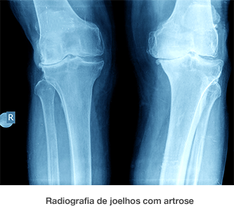 Dr. Marcelo Tostes Dr. Marcelo Tostes: Radiografia de joelhos com artrose