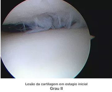 Dr. Marcelo Tostes Dr. Marcelo Tostes: Lesão da cartilagem em estagio inicial