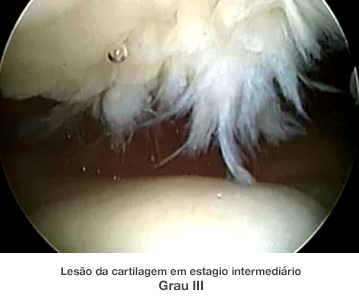 Dr. Marcelo Tostes Dr. Marcelo Tostes: Lesão da cartilagem em estagio intermediário