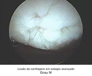 Dr. Marcelo Tostes Dr. Marcelo Tostes: Lesão da cartilagem em estagio avançado 