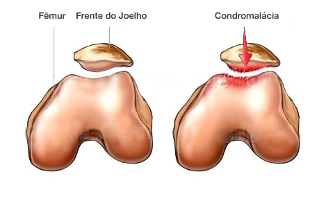 Dr. Marcelo Tostes Dr. Marcelo Tostes: Condromalácia - “Joelho Estalando”