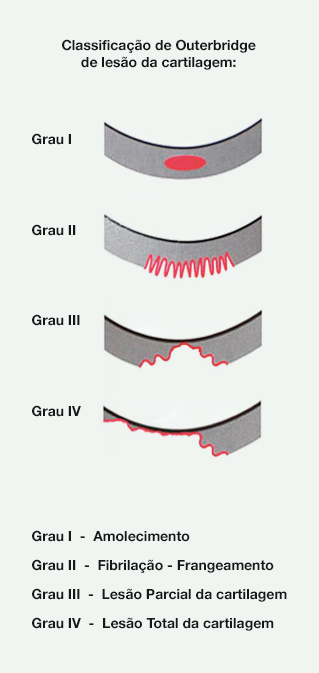 Dr. Marcelo Tostes Dr. Marcelo Tostes: Classificação de Outerbridge de lesão da cartilagem: