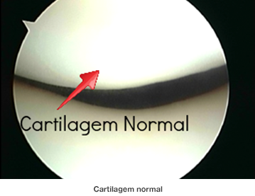 Dr. Marcelo Tostes Dr. Marcelo Tostes: Cartilagem normal