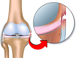 3 Formas de Fortalecer o Ligamento Colateral Medial (LCM)