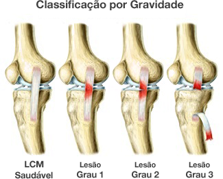 3 Formas de Fortalecer o Ligamento Colateral Medial (LCM)