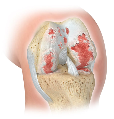 Dr. Marcelo Tostes Dr. Marcelo Tostes: Cirurgia - Prótese de joelho