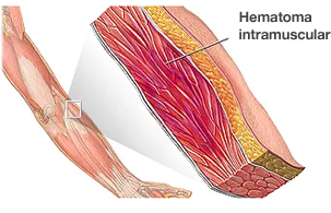 Dr. Marcelo Tostes Hematoma inframuscular