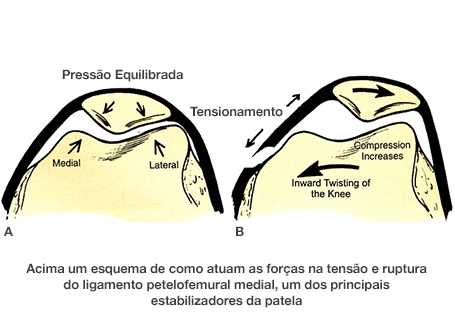 Dr. Marcelo Tostes Dr. Marcelo Causas da Luxação Patelar