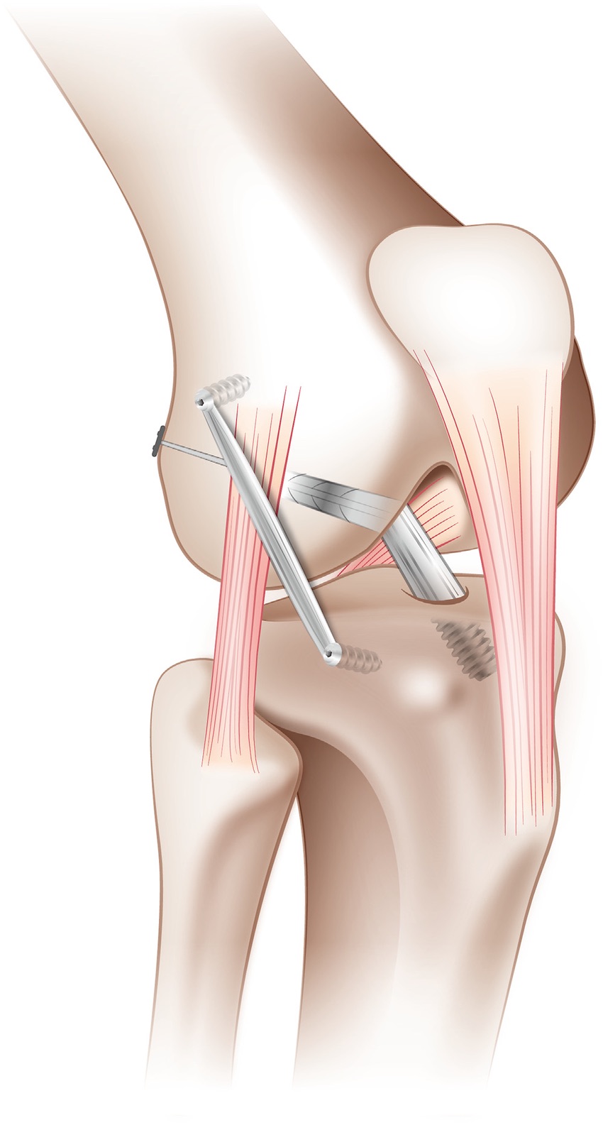 Dr. Marcelo Tostes Ligamentos do Joelho