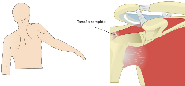 Dr. Marcelo Tostes Tendão Rompido