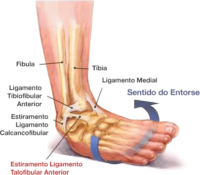 Dr. Marcelo Tostes Tornozelo,Fibula,Tíbia,Ligamento Medial,Ligamento Tibiofibular Anterior,Estiramento Ligamento Calcancofibular, Estiramento Ligamento Talofibular Anterior